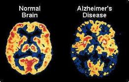 NeuroQuant® Dementia Imaging CT | Midstate Radiology